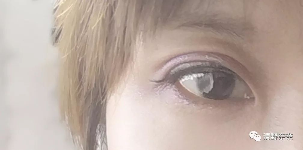 四十岁有法令纹川字纹医美项目,法令纹和鱼尾纹用医美怎么处理