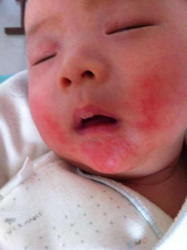 可怕！宝宝湿疹也会“烂脸”，原因是家长偷懒没做这件事