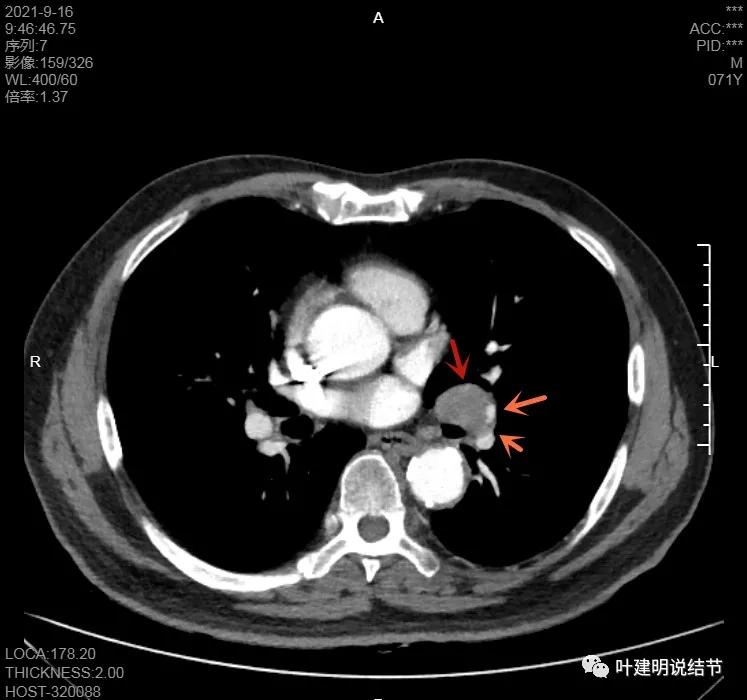 肺上有实性结节6mmx5mm是什么原因,肺上有1.7x1.8的实性结节该怎么办