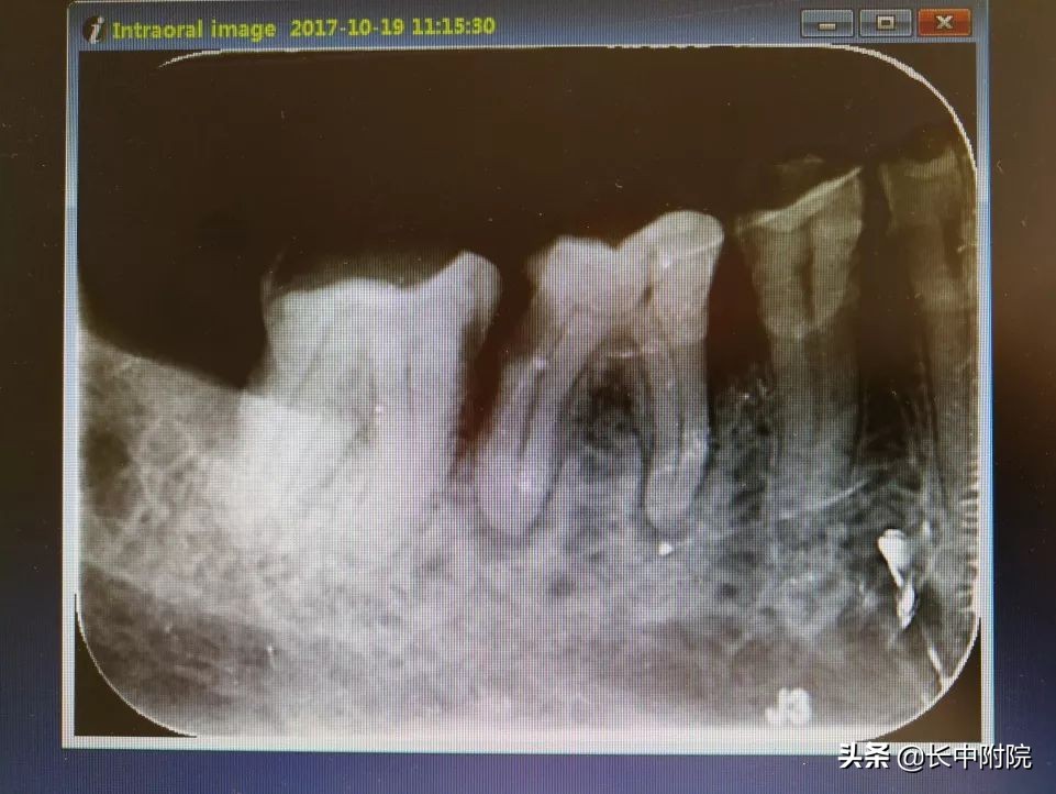 口腔根管治疗技术,口腔根管治疗怎么学好