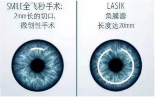全飞秒半飞秒激光手术哪个更好,飞秒激光制瓣是全飞秒还是半飞秒