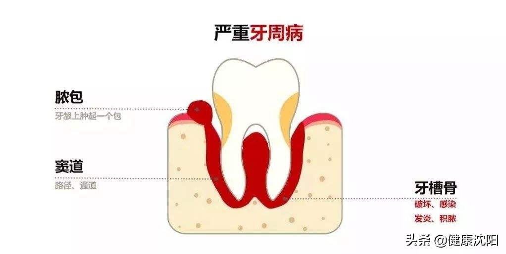 牙龈有脓包怎样引流,把牙龈里的脓水吃下去了怎么办