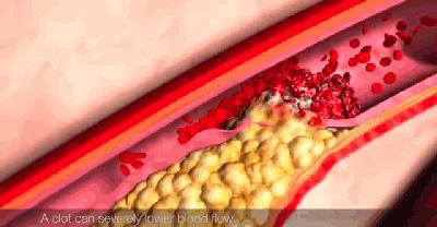 胸口压榨疼几分钟缓解,胸口有压榨性疼痛吃什么药