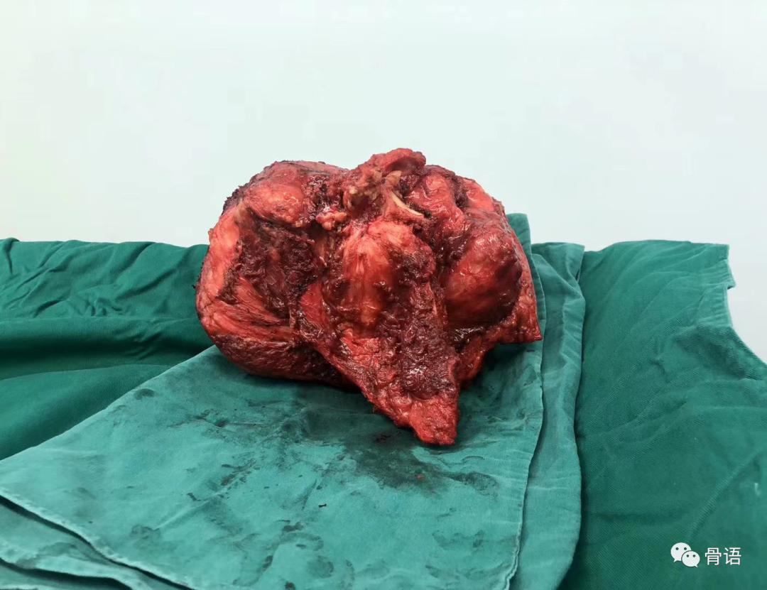 骨科恶性肿瘤,骨科软组织肉瘤是什么意思