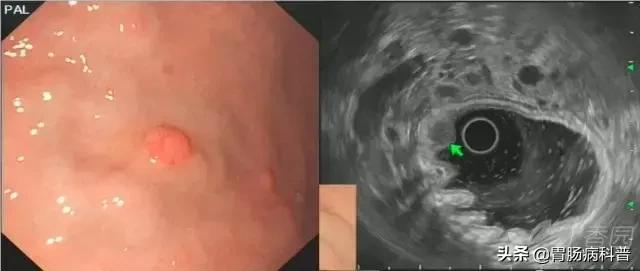 胃窦粘膜下隆起病变是胃癌吗,胃镜报告胃窦伴有隆起