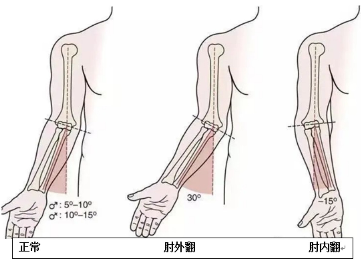 肘关节骨折出现的后遗症,肘关节陈旧性骨折肘内翻