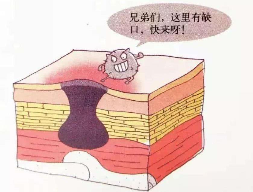 压疮和褥疮是一回事吗,压疮褥疮是一回事吗