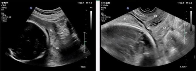 中央型前置胎盘要检查哪些项目,胎盘前置检查什么看得出来