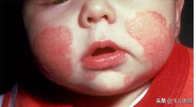 小孩长湿疹用什么方法最好,小孩起湿疹的最佳治疗办法