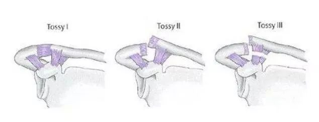肩锁关节脱位复位视频,肩锁关节脱位固定带