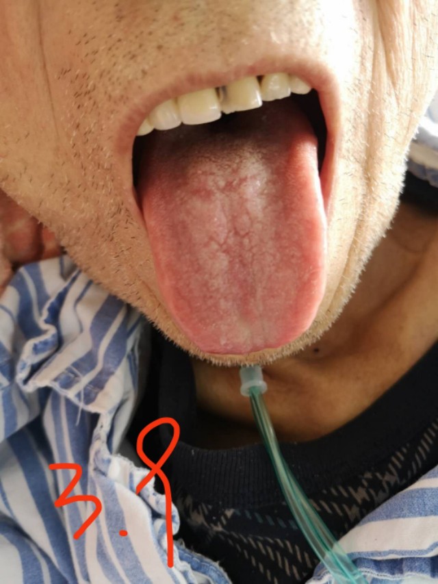 中西医结合治疗原因不明肠梗阻、腹水转氨酶明显升高病案一例！