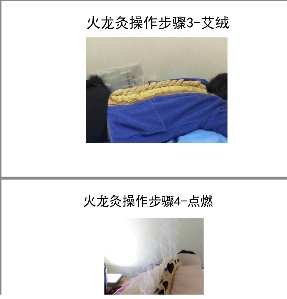 卵巢早衰扎针灸效果如何,卵巢早衰闭经针灸治疗有效吗