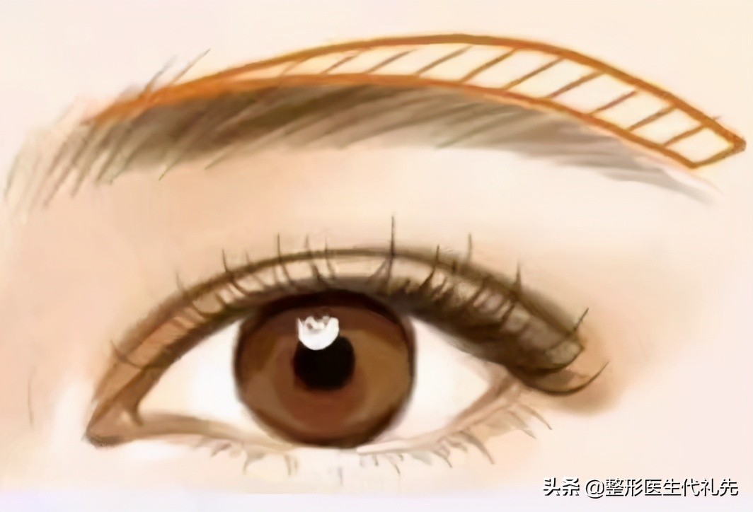 提眉最多一生能做几次提眉,提眉手术怎么操作