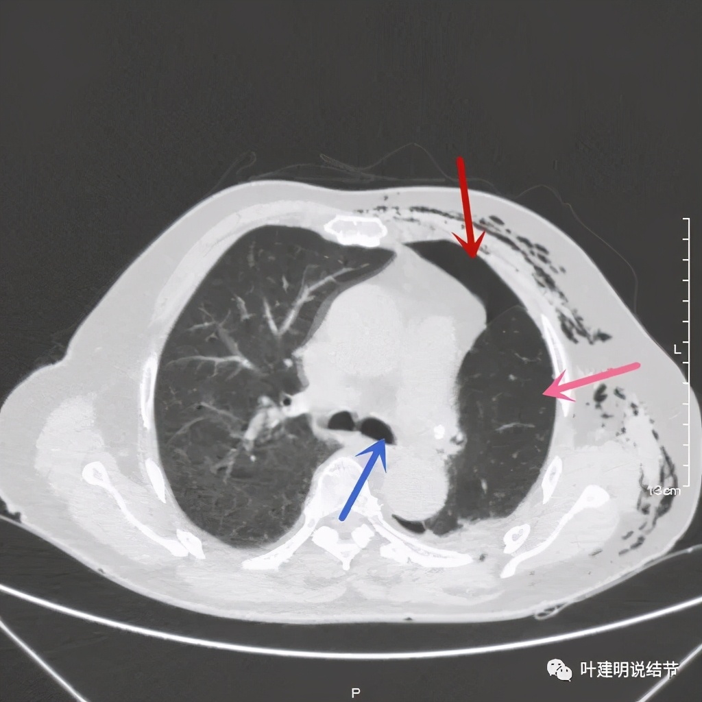 中央型肺癌手术前辅助治疗,中央型肺癌治疗后活过10年的病例
