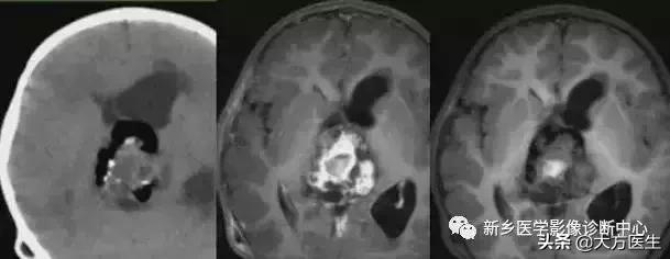钙化灶是良性肿瘤的可能性大吗,颅内肿瘤钙化发生率最高