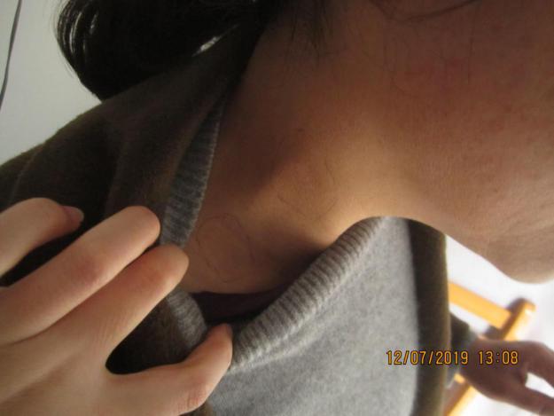 白癜风女子坚持抗复发,白癜风康复了的女孩