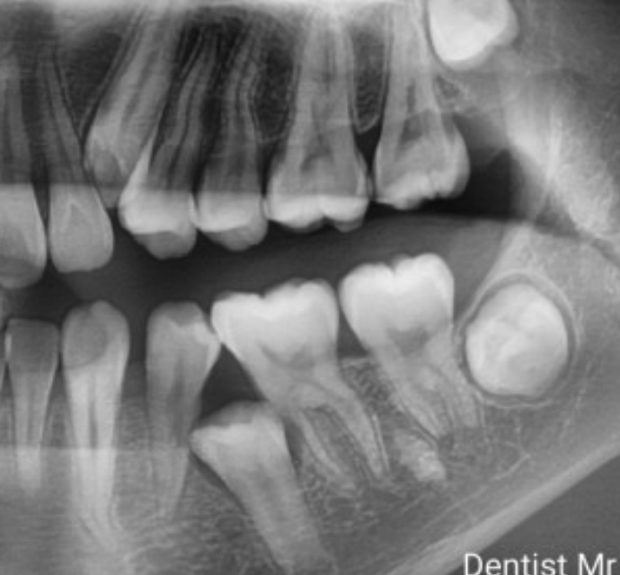 流体树脂补牙优缺点,补牙为什么会用塑料