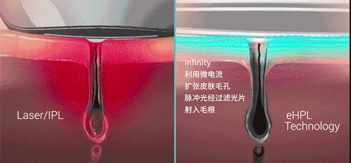 脱毛方法排行榜第一名,目前最好的脱毛技术