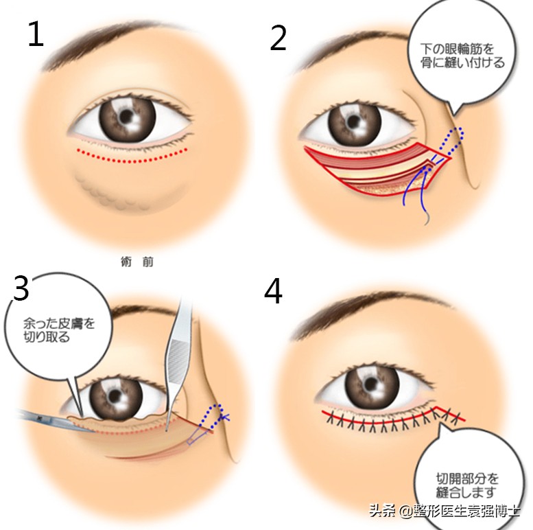 做眼袋都需要问医生什么问题,做手术前要咨询医生哪些问题