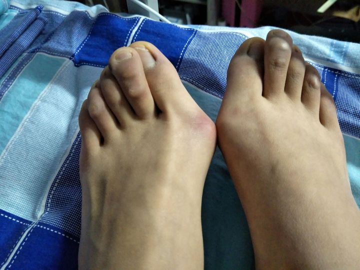 大脚骨判断标准,大脚骨自测方法