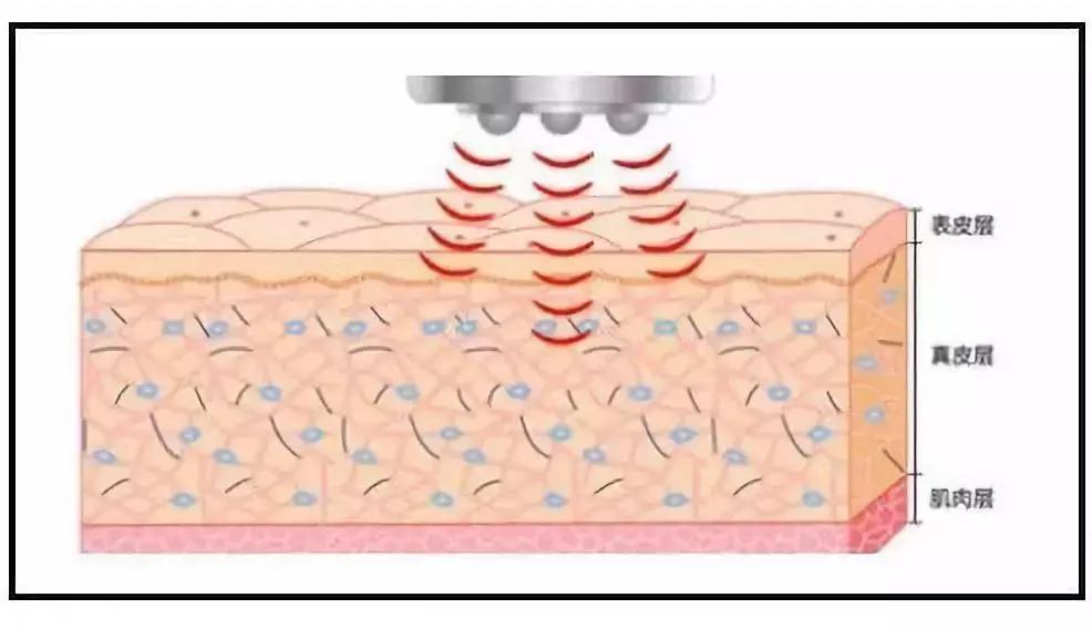 十年光学美容仪,初学者应该怎么选择美容仪