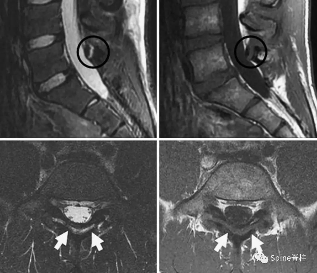 青少年一跑步就腰痛,青少年腰痛是什么原因引起的