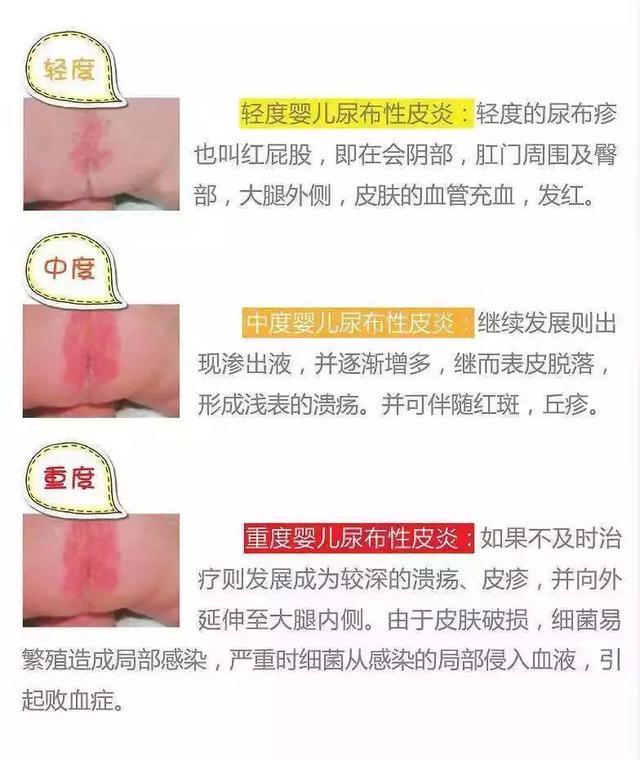 接触性皮炎的症状表现图片,接触性皮炎几天会好小妙招来帮你