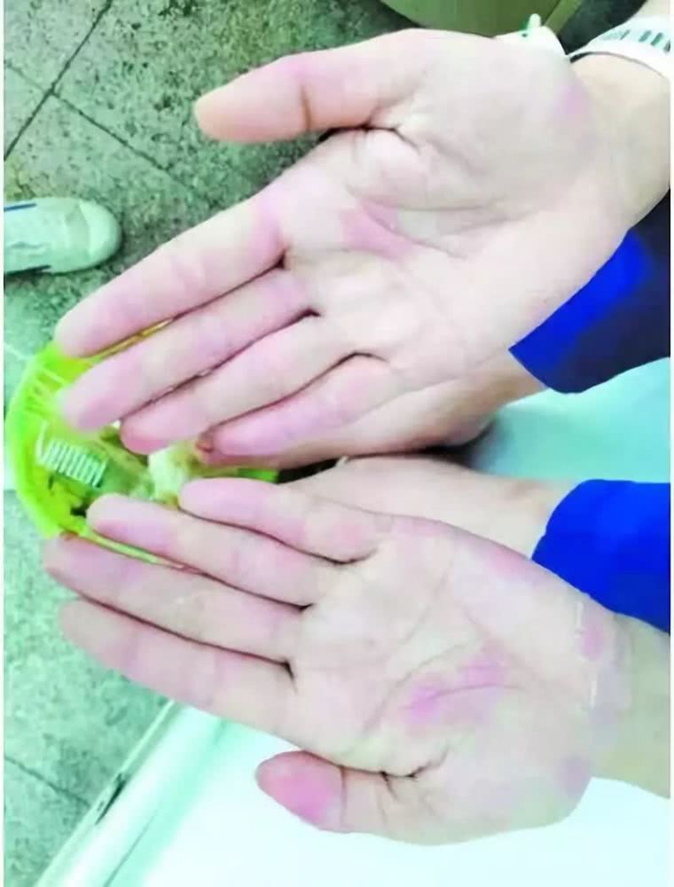 江门新会一少女天天吃鱼,手脚竟“满目疮痍”!医生一句话说出真相