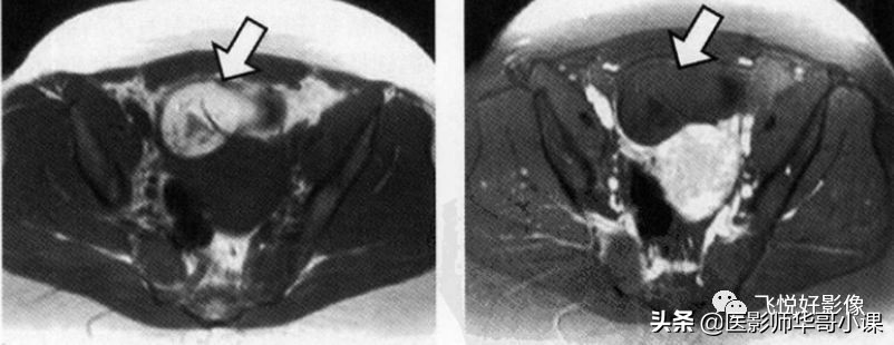 飞利浦磁共振独有技术,飞利浦磁共振减影技术