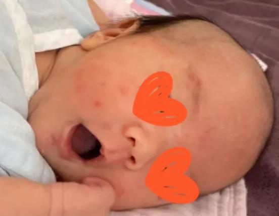 养宠物会不会造成孩子湿疹,宝宝湿疹跟家里养宠物有关系吗