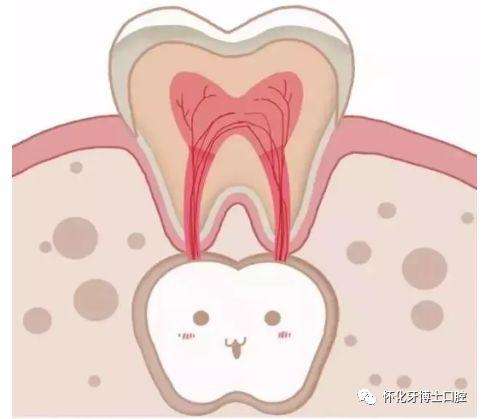 乳牙坏了不用管等换牙可以吗,乳牙坏了不做根管可以直接补吗