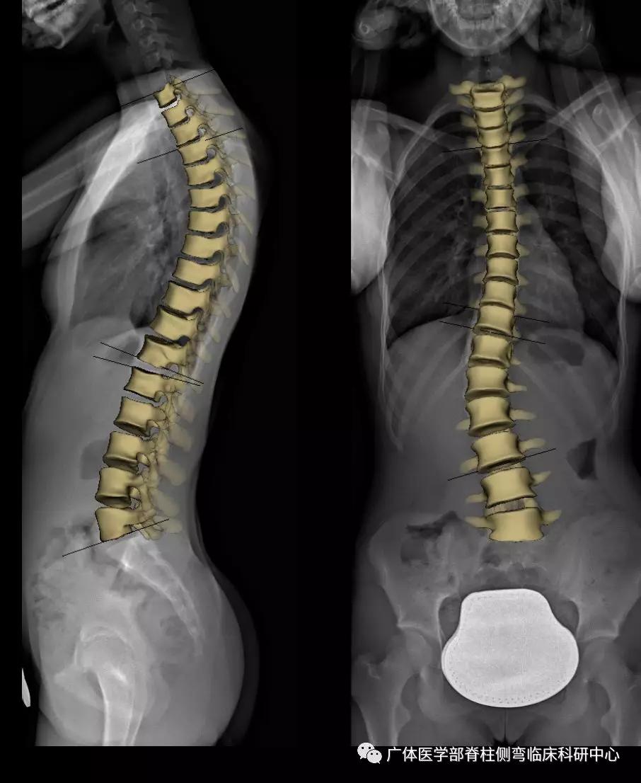 脊柱侧弯3d演示推拿,脊柱侧弯3度图片