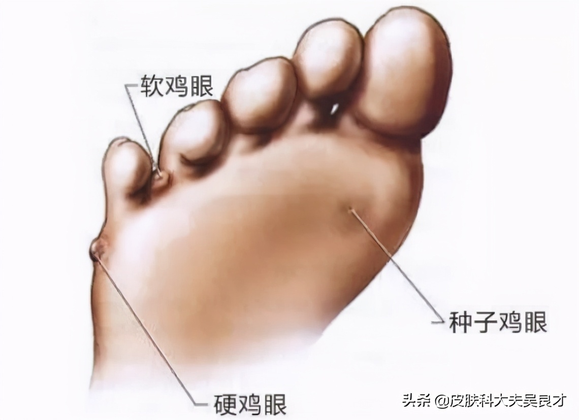 看完这篇文章后学到了什么,鸡眼和跖疣最简单的区别