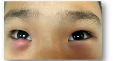 王小姐眼睑肿胀成一个“球”，经过治疗恢复如初