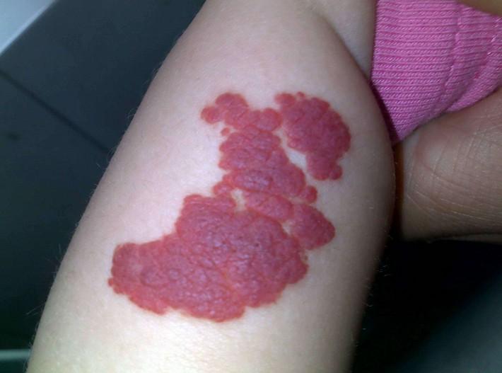 血管瘤鲜红斑痣是什么原因造成的,鲜红斑痣是不是比血管瘤厉害难治