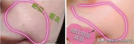 一次水光等于1000张面膜是真的吗,打水光针有副作用吗有依赖性吗