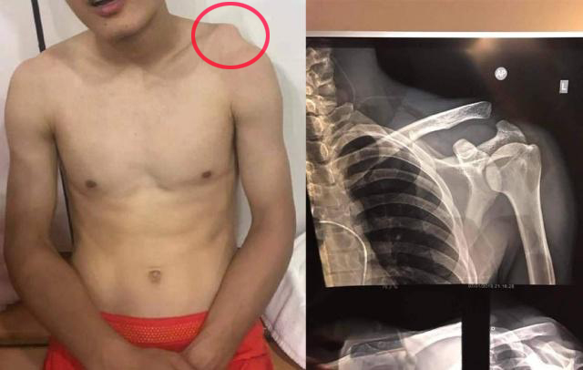 运动员为什么不建议打封闭,打封闭对运动员有什么好处