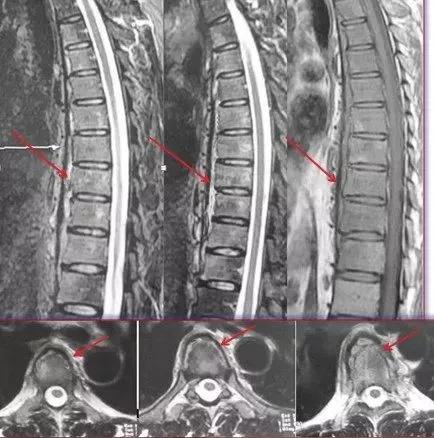 脊柱结核保守治疗大约需要多少钱,脊柱结核可以保守治疗