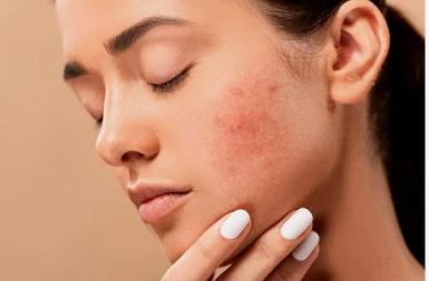 战痘真的很重要吗,战痘吧怎么样