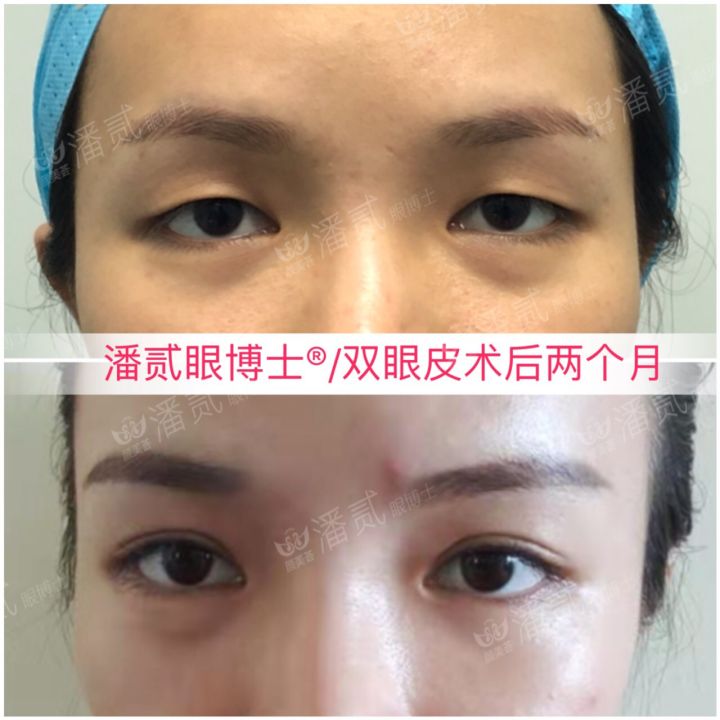 割了开扇双眼皮眼尾上扬太宽,眼尾上扬的眼睛适合什么双眼皮