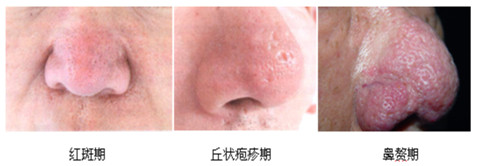酒糟鼻如何应对,酒糟鼻是常见的美容病该如何应对