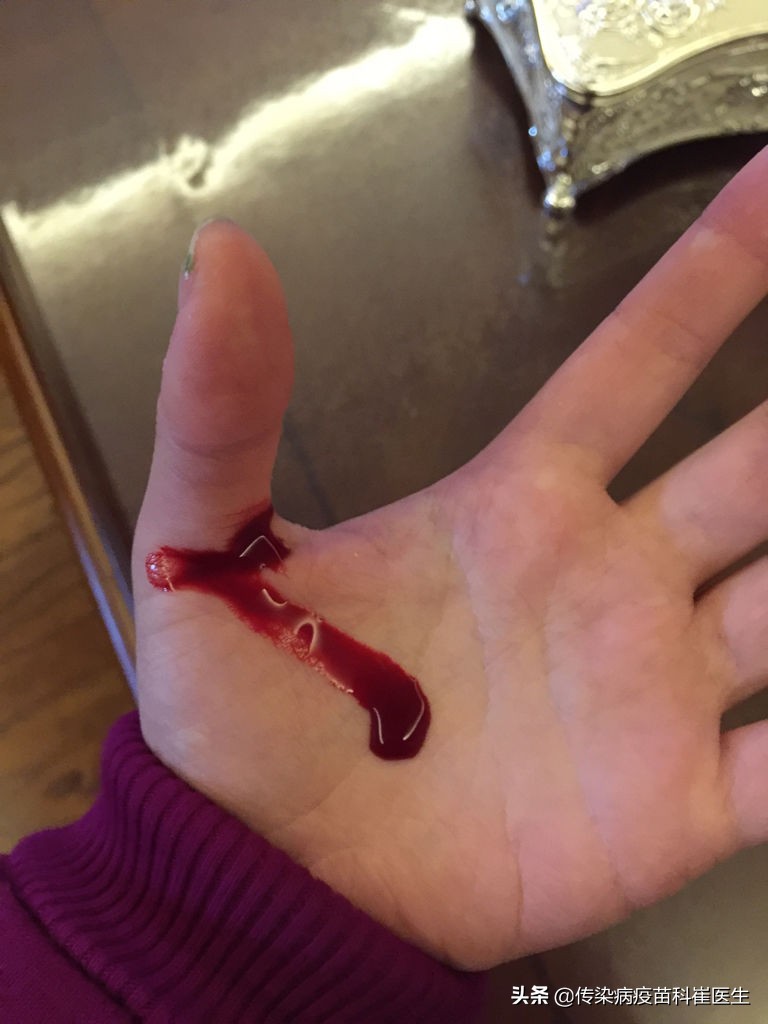 破伤风影响接种新冠疫苗吗,打了破伤风可以打新冠肺炎疫苗吗