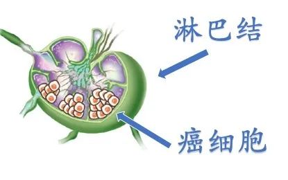 甲状腺术后见异常淋巴结什么意思,甲状腺术后病理有淋巴结转移2枚