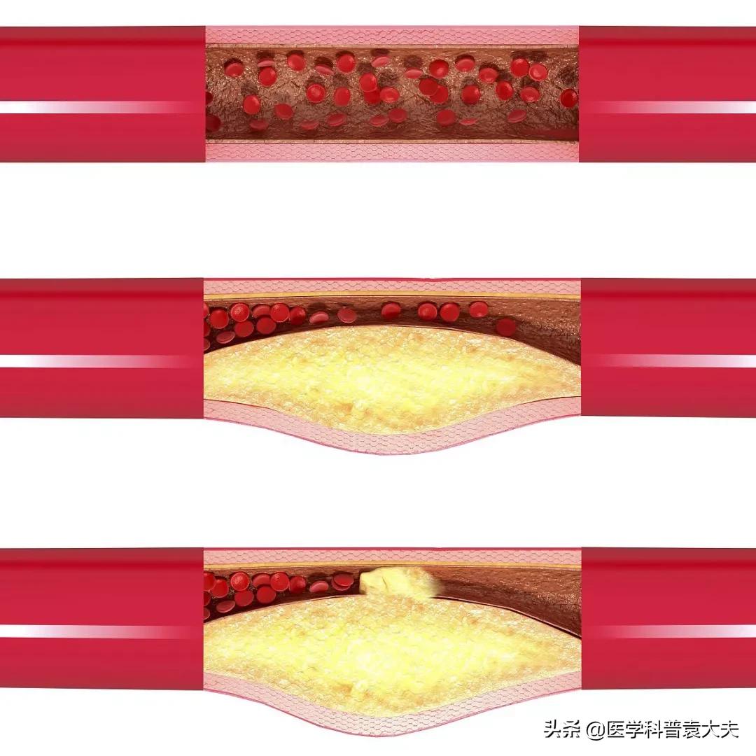 医生治疗心脑血管,医生科普心脑血管疾病