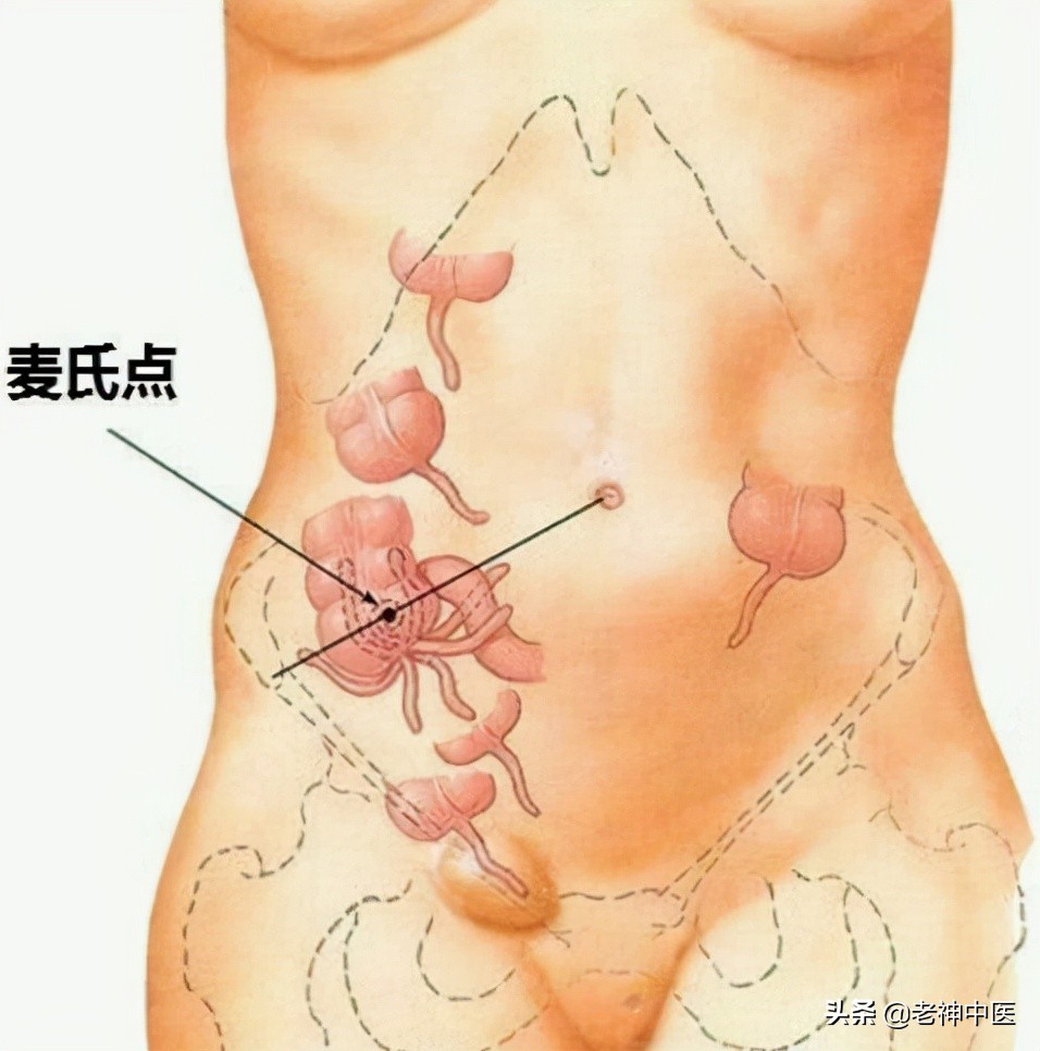 慢性阑尾炎大黄牡丹汤医案,大黄牡丹汤治疗阑尾炎原方