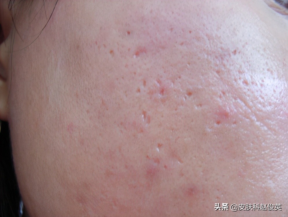 孕早期口内生疮咋办,哺乳期乳房生疮是什么症状