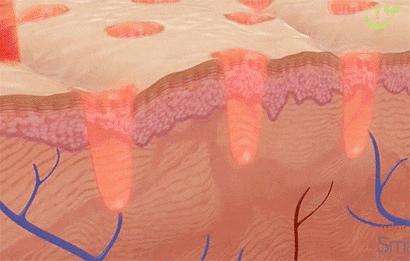 “毛孔粗大”粗的并不是“毛孔”,它是瘢痕呀！三种方法有效解决