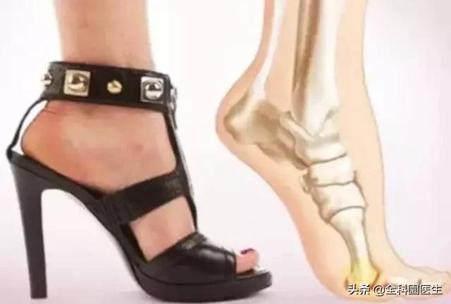 拇外翻宽楦适合的鞋子,男士拇外翻如何选鞋子