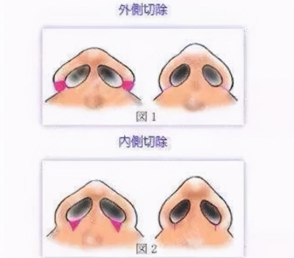 好看的鼻子类型驼峰鼻,好看的鼻型有哪几种