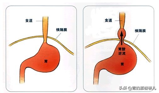 儿童慢性胃炎怎么能彻底治愈,儿童慢性胃炎怎么治疗好得快